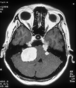 Neurofibromatose