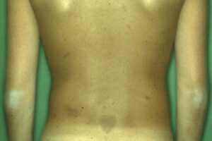 Neurofibromatose