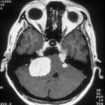 Röntgenaufnahme von Schädel mit Akustikusneurinom